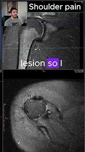 Glenoid labrum tear | MRI SCANS Ep. 5 #medicalimaging #mriscan #radiology #shoulderpain