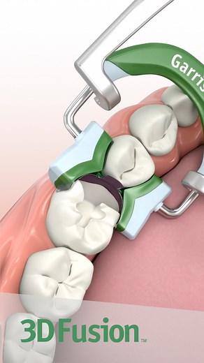 Schritt für Schritt zur perfekten Restauration, selbst bei weit aufgezogenen Kavitäten! ✨🦷 1. Band einsetzen 2. Keil platzieren 3. grünen 3D Fusion Ring anbringen – fertig für präzise Kontakte mit dem 3D Fusion System von Garrison! #DentalTools #GarrisonDental #3DFusion #RestaurativeDentistry | Garrison Dental Solutions
