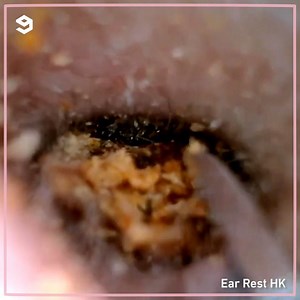 111K views · 317 reactions | My eyes: disgustang! My brain: keep watching By Ear Rest HK 香港專業耳道清理 | 9GAG Vibes | Facebook