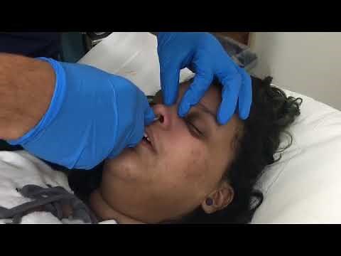 Nasal fracture closed reduction