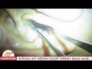 👉 ASMR Lấy Ráy Tai: Lấy Ráy Tai Sau Nhiều Năm – Cảm Giác Thật Thoải Mái