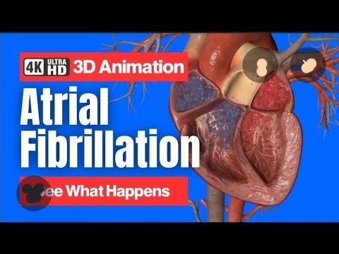 Atrial Fibrillation / Heart Disease / Irregular Heart Beat /