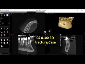 CS 8100 3D Fracture Case