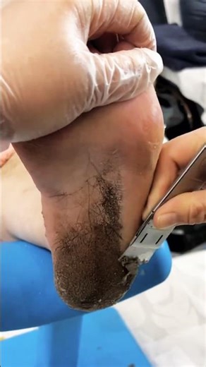 Dry & Thick Callus Care | Professional Foot Care#callusremoval #cornremoval #pedicure