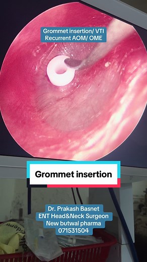 Grommet Insertion for Recurrent AOM and OME