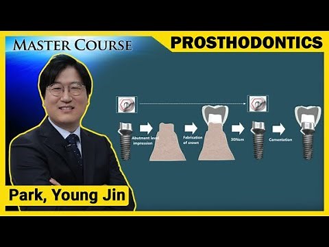 [Master Course Season2 -PROSTHODONTICS] Implant Impression Taking
