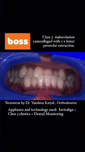 Invisalign makeover for Class 3 crossbite - Before and after time lapse video