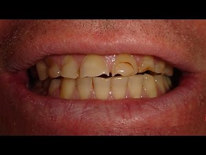 Freehand Composite Veneers Demonstration