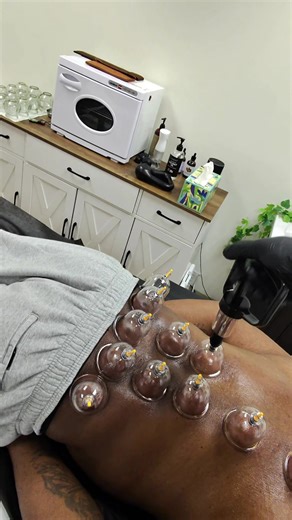 He couldn’t believe how loose and relaxed he felt after this dry cupping session. By improving local circulation and helping tight tissue release, dry cupping allows the muscles and nervous system to calm down, which is why many people feel lighter, freer, and more mobile afterward. #cuppingtherapy #thecupdoc #cupping #hijama #drycupping