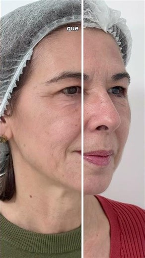 Before and after a liquid facelift