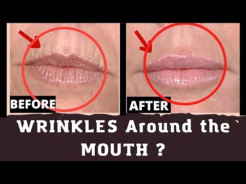 How to Get Rid of Wrinkles around the Mouth ? upper lip wrinkles