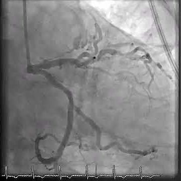 Coronary Angiogram with LAD Artery Stenosis