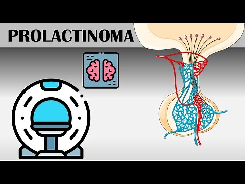 Prolactinoma - Causes, Risk Factors, Signs & Symptoms, Diagnosis, And Treatment