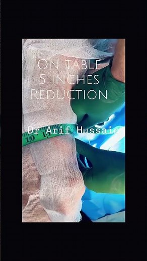 Transforming Arms with Avulsion Brachioplasty: 5-inch Reduction Before & After #bodygoals