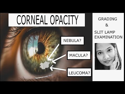 Corneal Opacity - Grading & Clinical Examination | Adherent Leucoma| Nebular, Macular & Leucomatous