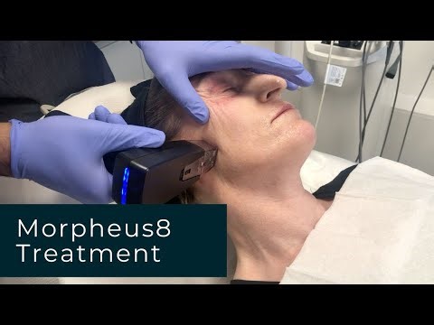 Morpheus8 Treatment | Everything You Need To Know
