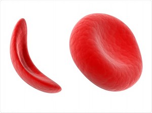 Sickle-Cell Disease History