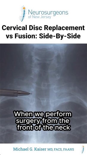 Cervical Disc Replacement vs. Fusion: Side-by-Side - Dr. Michael Kaiser MD, FACS, FAANS