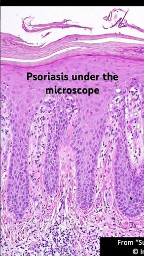 Psoriasis skin biopsy under the microscope - What the pathologist sees! #pathology #dermpath