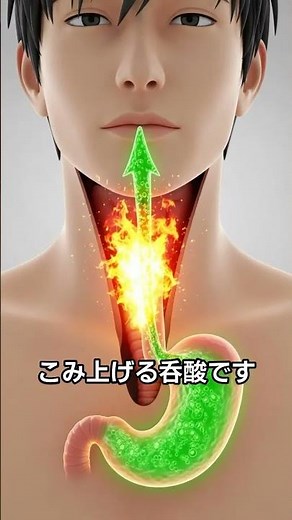 逆流性食道炎の原因・治療・食事まで完全ガイド｜PPI/PCABの使い分けも解説