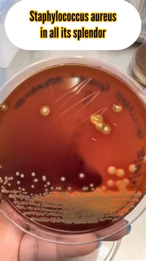 🧫 Staph Spotlight: The Abscess Chronicles 🔬 From blood to chocolate agar, witness the golden glow of Staphylococcus aureus in full bloom 💛 ⚡ Beta hemolysis slicing through blood agar ⚡ Salt & mannitol revealing yellow fermenting warriors ⚡ Chocolate agar? Still golden, still bold. This isn’t just microbiology—it’s microbial drama. #LabLife #MicrobeMagic #StaphStories #GoldenColonies #ISPITSChronicles #ReelScience #BacteriaBeauty Scientific Forum For Microbiology and Parasitology Medical Labor