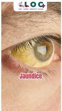 Why Does Jaundice Keep Coming Back? Dr. Maneesh Paliwal Explains