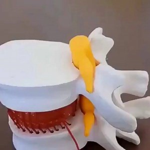 5.7K views · 69 reactions | - Lumbar Disc Herniated Model 類 ------...