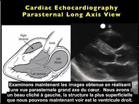 Comment : Réaliser une échographie cardiaque : vue parasternale grand axe, 1ère partie
