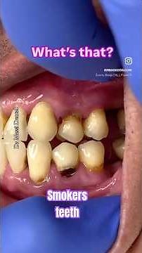 Effects of smoking and vaping on oral health