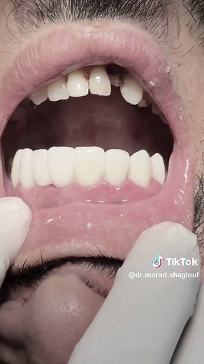 Scaling Calculus & Tartar Off Zirconia Crowns | UK Dentist