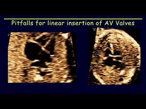 Normal variants and pitfalls in fetal echocardiography