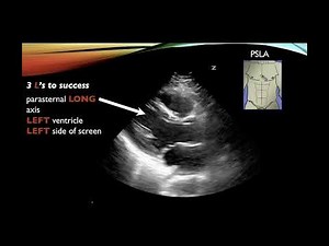 Basic Cardiac Ultrasound Views and Pathology - Echocardiography