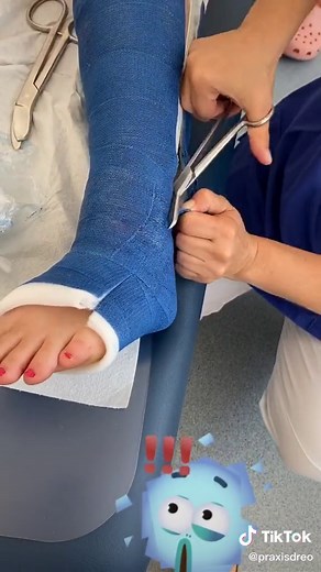 Gips entfernen: So entfernen wir bei uns in der Praxis einen Gips