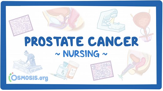 Prostate cancer: Nursing: Video & Causes | Osmosis