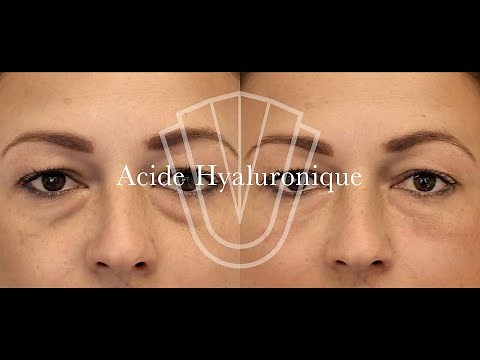 Acide Hyaluronique - Cernes