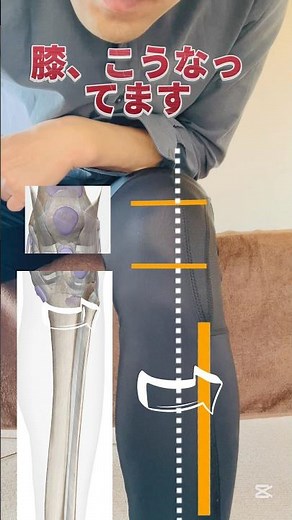 [Knee Pain] Common characteristics of people whose knees hurt when walking #kneepain #osteoarthri...