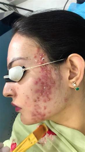 Get Rid of Scars from the Right Treatment by Certified Dermatologists| Skinaa Clinic|Clear Skin