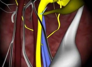 Inferior Alveolar Nerve Block Injection | Hair O Dent - FUE Hair Transplant - Kochi & Calicut