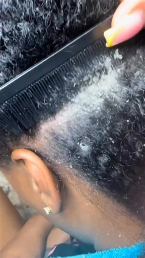 95K views · 389 reactions | My scalp has been on 100 these last few weeks My niece is scratching my scalp and before i yall come for her I TOLD HER DONT COMB it OUT Just lift off my scalp This how your hair falls out and be thin by ripping it through the small tooth comb Itll wash out sebboricdermatitis sebborheicdermatitis fyp scratching flakes dandruff awareness | Meneawara Precious Barilunanee | Facebook