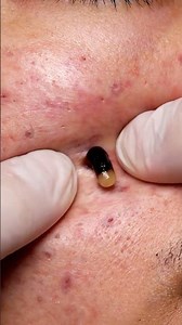 “Cheek Blackhead Removal on Rough Acne Skin” #blackhead #gross #natural