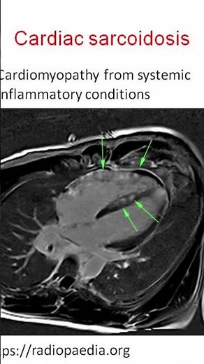 Cardiac sarcoidosis