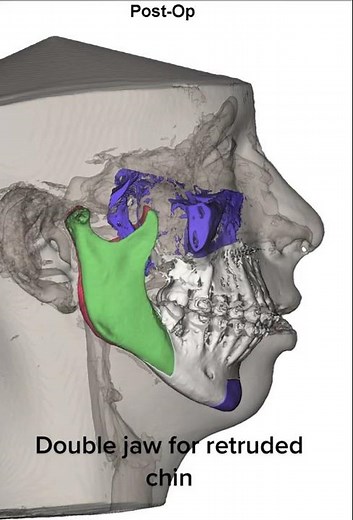 Surgical program of a class III malocclusion