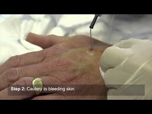 How to perform a shave biopsy on the hand