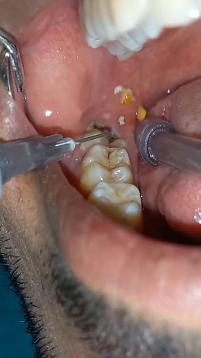 Wisdom Tooth Removal: Understanding the Procedure and Recovery