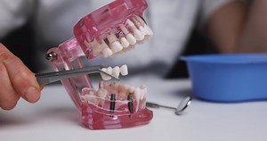 Dentist Implantologist Showing Dental Bridge Implant Stock Footage Video (100% Royalty-free) 1063817767 | Shutterstock