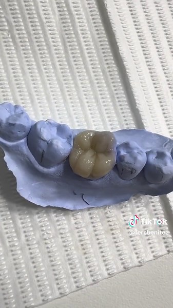 Incrustación dental: ¿Qué es y cómo se realiza?