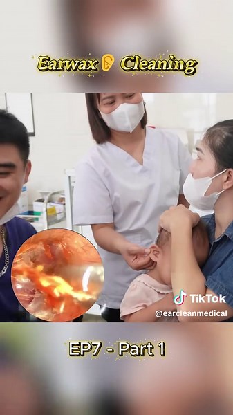 Earwax👂Cleaning {for kids} #ear #earwax #earcleaning #Earwaxcleaning #earwaxremoval