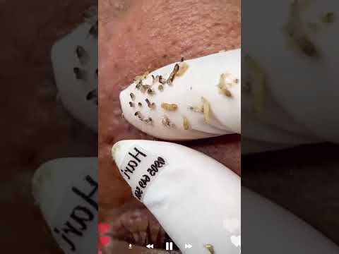 Skincare | Blackheads Removal #744 #tweezers skincare #blackheads blackheads