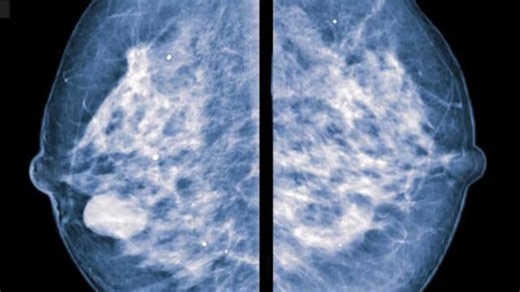 Contrast-enhanced mammography can identify 3x as many tumors in dense-breasted patients, study says
