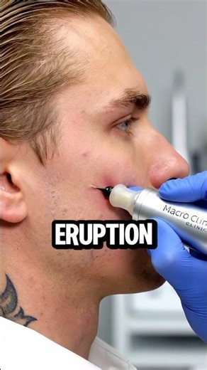 Pimple Popping the "Forbidden Noodle" from an ANGRY Volcano!